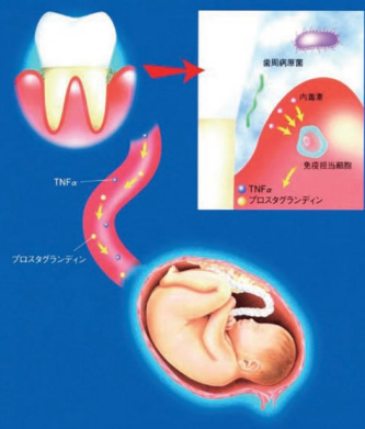歯周病菌の内毒素は、免疫担当細胞を刺激して種々の活性